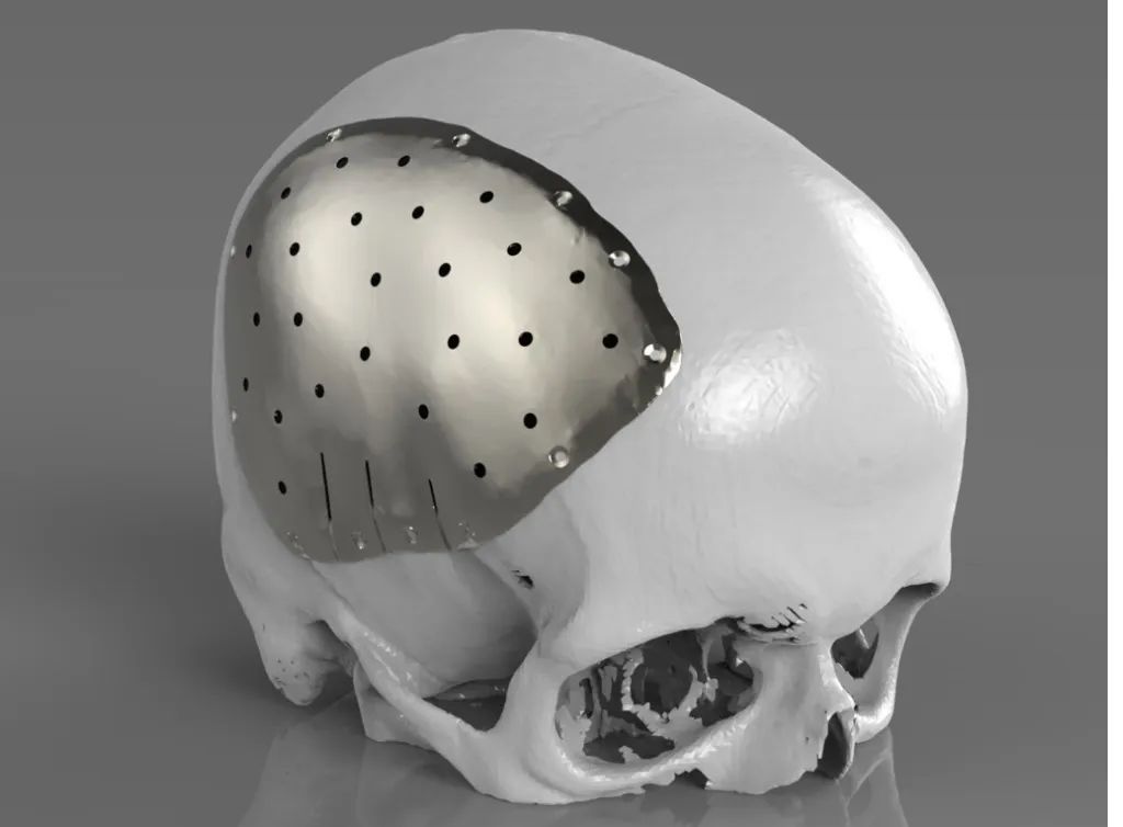 PEEK - Advanced material for cranioplasty