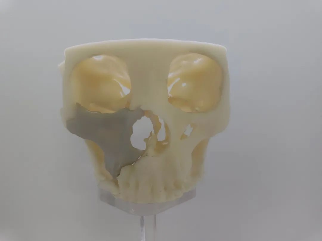 PEEK - Advanced material for cranioplasty