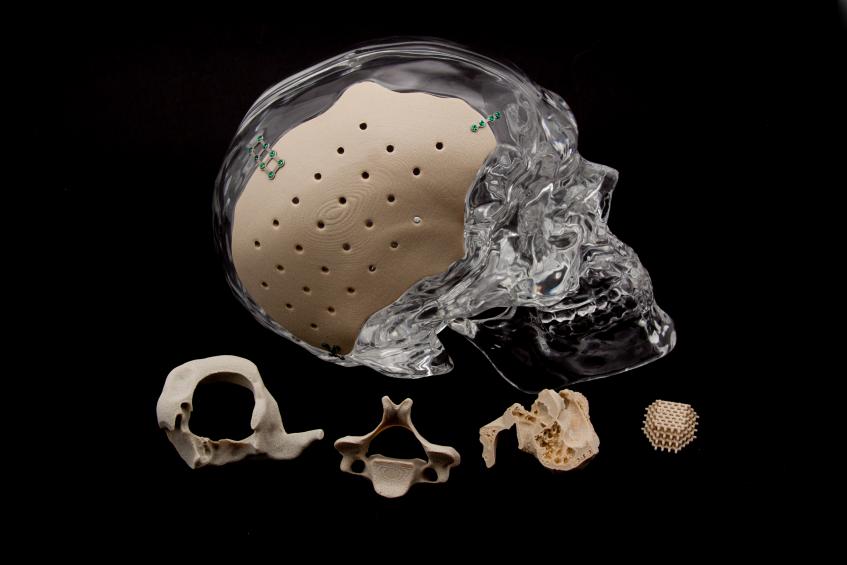 Basel Hospital 3D Prints First On-Site PEEK Maxillofacial Implant