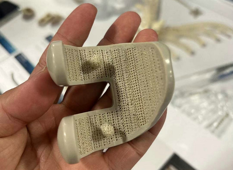 Medical-Grade 3D Printed PEEK Implants