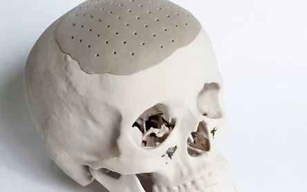 PEEK - Advanced material for cranioplasty